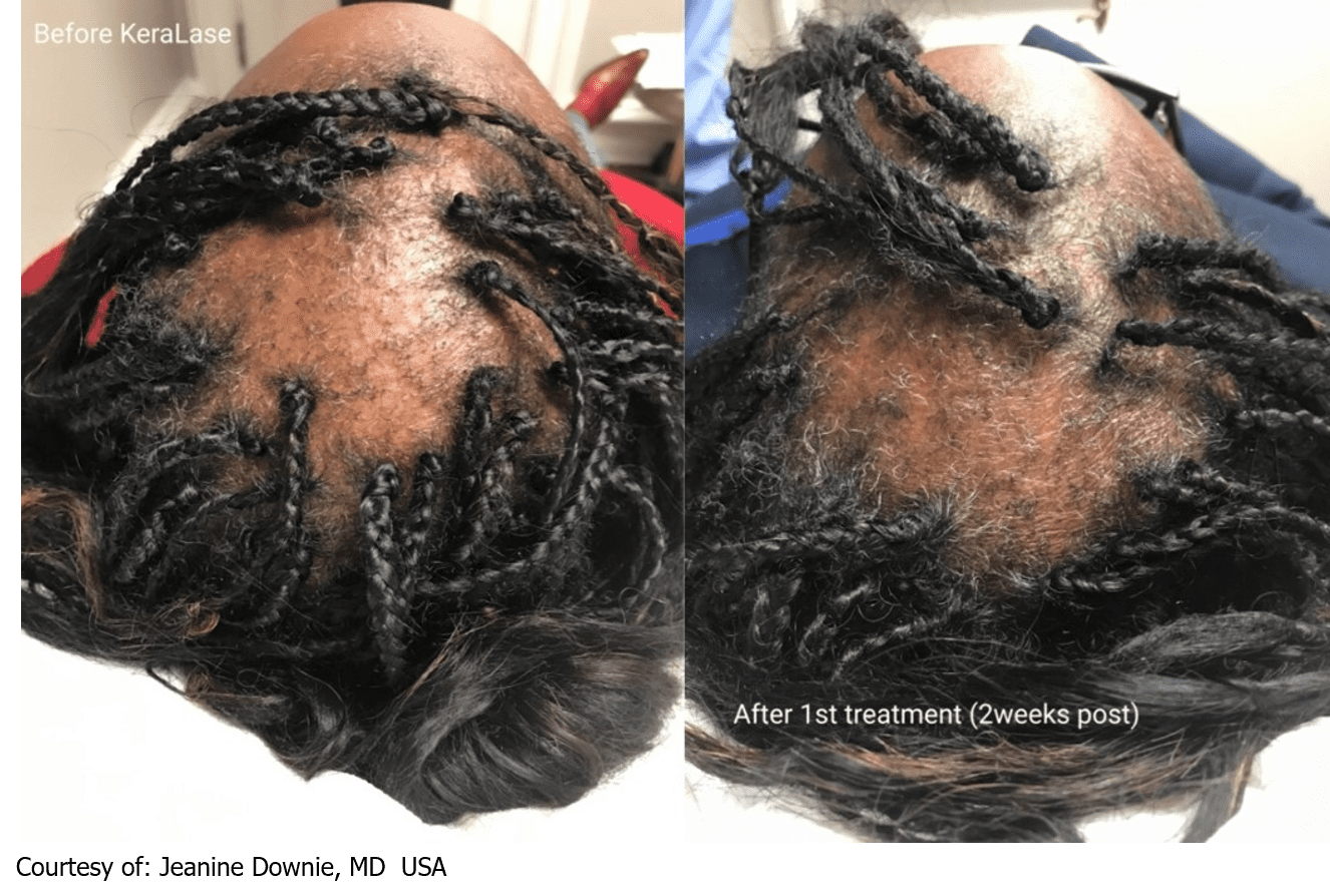 hair-loss-hair-growth