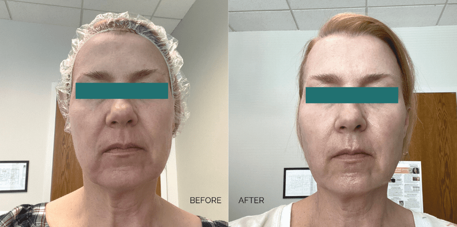 genius-microneedling-treatment-before-and-after genius-microneedling-treatment-before-and-after