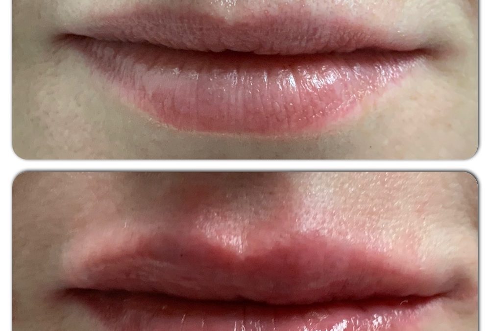 RHA® Fillers for Wrinkles and Creases!