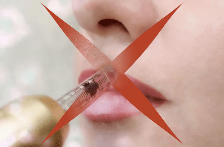 Debunking Hyaluronic Pens, a Dangerous Substitute for Lip Fillers