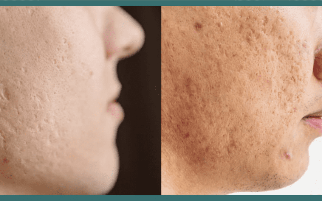 Get Rid of Acne Scars to Look & Feel Your Best!